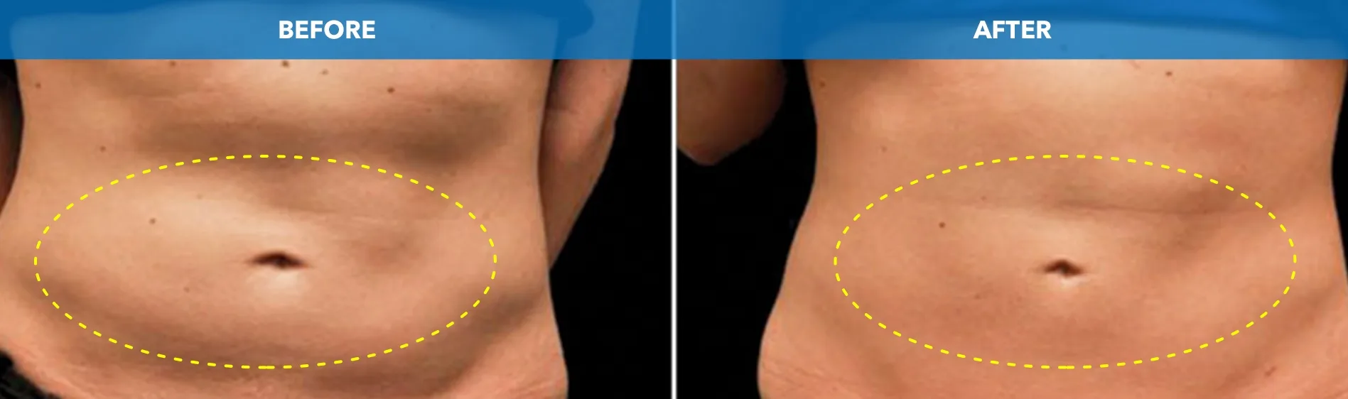 Abdomen with the treated area outlined before and after CoolSculpting fat freezing at Cool Clinic in London